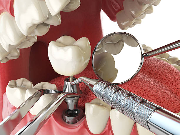 Best Emergency Tooth Extraction in Williamsport, IN